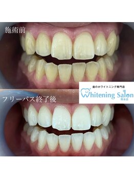 ホワイトニングサロン 熊本店/誰でもホワイトニング