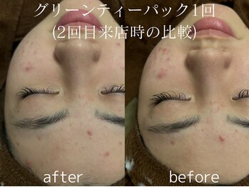 グランクウォーレ(Gran Cuore)/ニキビケア★