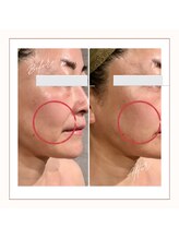 サンテボーテ(Sante Beaute)/【幹細胞導入＆小顔リフト2回】