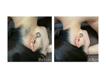 エクラ(ECLAT)/うなじ脱毛♪