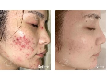 カノン(Kanon.)/リベルハーブピーリング