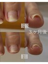 巻き爪補正経過3-右(20代女性)