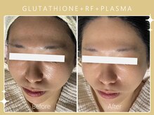 ハノハノ 八代店(HANO HANO)/グルタチオン+RF+プラズマ☆
