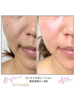 リサプリ(Re: Supple)/毛穴・肌は“育てる”へ
