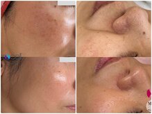 ラシュシュ(La chou chou)の雰囲気（プロセル！毛穴/ニキビ/シワ/たるみ/ハリ/シミ/くすみ）