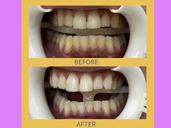 ココティ ホワイトニング(Cocotii)/ビフォーアフター