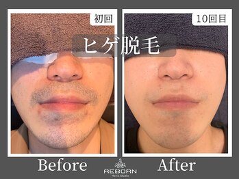 メンズスタジオ リボーン(REBORN)/顔脱毛/ひげ脱毛/松山
