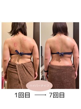 若松整体院 太白区院/ハイパーナイフ！