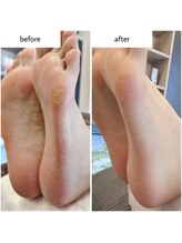 ケアプラス(care plus)/足裏角質ケア