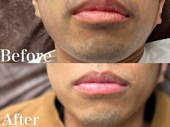 ボス 岡崎店(BOSS)/【メンズ脱毛/ヒゲ脱毛】