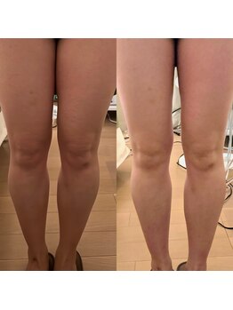 シーアイエステティック 船橋駅前店(c.iエステティック)/よもぎ&EMS&揉み出し