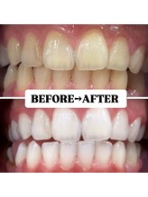ホワイトニングサロン 豊中/Before&After美白ホワイトニング