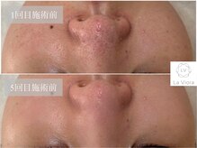 ラヴィオーラ 西大寺(La Viora)/ダイヤモンドハーブピーリング