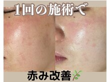 カッカ(kakka)/ハーブピーリング