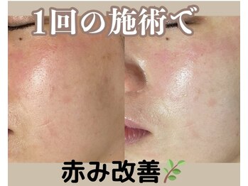 カッカ(kakka)/ハーブピーリング