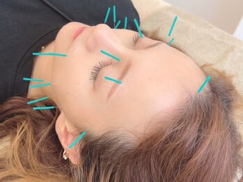 ヒーリングサロン アージュ(A-je)の写真/【美肌小顔★美容鍼+小顔矯正コース】A-jeの人気定番メニュー♪スッキリとしたフェイスライン＆美肌が叶う!
