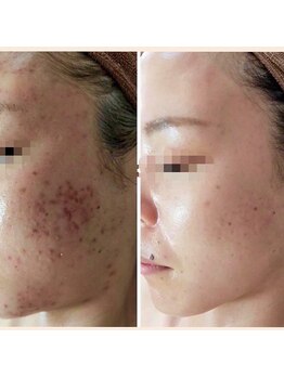 エヌーサ(Enoosa)/☆光フェイシャル☆