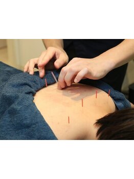 鍼灸施術を受けたい