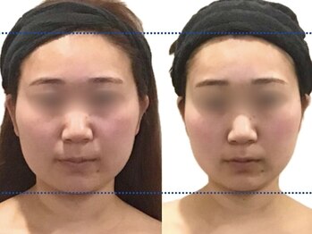 小顔フェイスラボ 浜松店(小顔FaceLabo.)/◆小顔コルギ Before→After◆