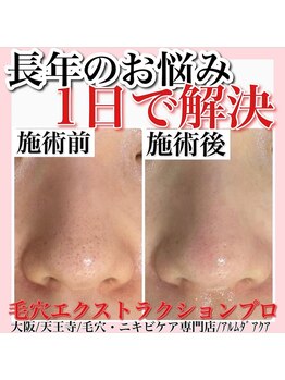 アルムダアクア 天王寺店(Aleumda AQUA)/毛穴エクストラクションプロ