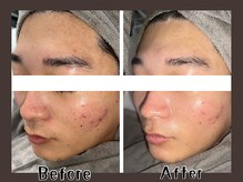 ハル(HARU.)の雰囲気（ハーブピーリング １回でこの変化☆）