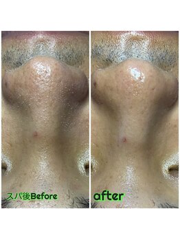 ビービー(BB)/#メンズ #毛穴洗浄