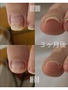 巻き爪補正経過1-左(20代女性)
