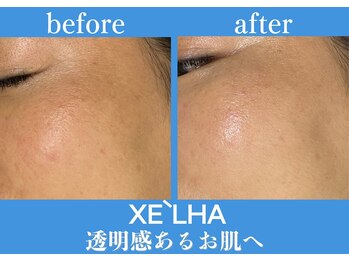 【シミケア/ハーブピーリング専門店】パールホワイトニングサロン 大船店/毛穴洗浄と韓国ピーリング