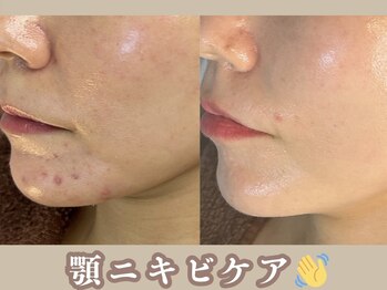 カッカ(kakka)/ハーブピーリング