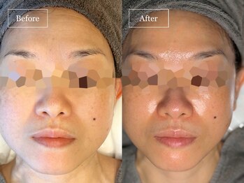 キュレイテッドスキン(CURATED SKIN)/ピーリング/毛穴ケア/肌質改善