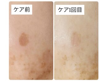 ミラージュ(Milarju)/30代からのシミ改善!!