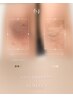  《肘or膝orくるぶし》　韓国大人気ルメラ使用！実績数関西1★