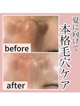 ゴールデンケア(goldencare)/エステしかできない本格毛穴ケア