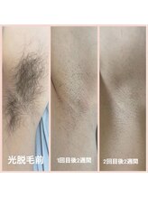 ワイズサロン(Y's salon)/男性ワキ脱毛！