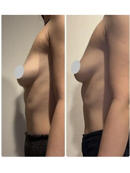 メディカルエース(MedicalAce)/授乳後のバストケアへも！