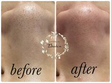 ニコサロン(25salon)/ハイドラフェイシャル