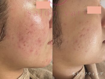 サロンヴェアリー 広尾(salon vary)/#ニキビケア#敏感肌