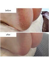 ケアプラス(care plus)/足裏角質ケア