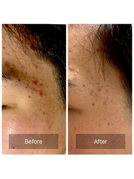 ビジュープラス 筑西下館店(Bijou+)/【18歳お悩み】ニキビ赤み