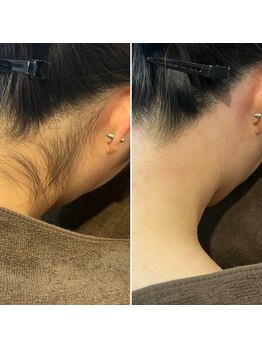 トリプルワン(111)/うなじ脱毛