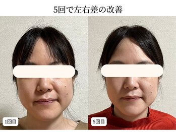 ドリームスパ 武蔵小杉店(DREAM SPA)/小顔before→after