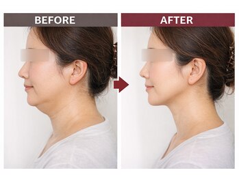 エステティック ライム(Esthetic Lime)/切らないフェイスリフト速攻小顔