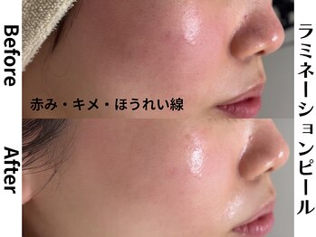 ユンプラス(yun+)/【小顔・むくみ】ラミピール