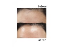 エクスクラメーションマーク(!!!)/プラズマフェイシャル