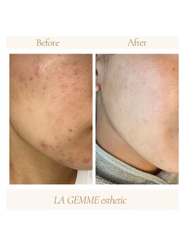 ラジェム(LA GEMME)/水素ハイドロ＋美顔フォト