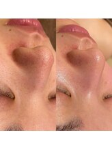 フォルチェ 春日(Folche)/毛穴の黒ずみ/ざらつき/ゴワつき