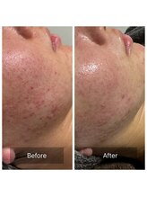 マヴィ(Mavie)/ハーブピーリング　Before After