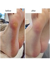 ケアプラス(care plus)/足裏角質ケア