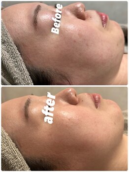 オーパーツ(OOPARTS)/ハーブピーリング/シミ/毛穴