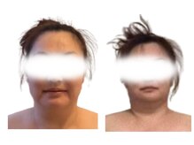 ビーエムビー(BMB)/小顔調整コース